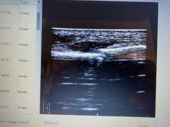 超音波画像観察装置でみる⑦　腓骨骨折