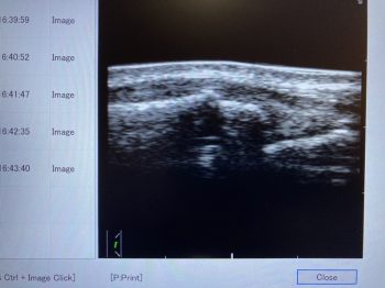 超音波画像観察装置でみる⑧成長期の橈骨骨折
