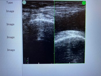 超音波画像観察装置でみる⑨　80代女性　膝関節水腫